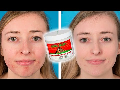 People Try The Aztec Healing Clay Face Mask For Their Acne